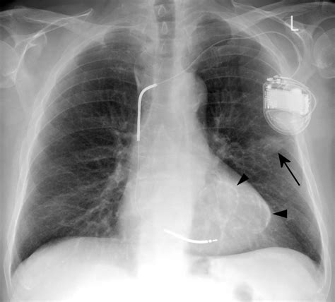 left ventricular aneurysm radiology.